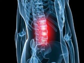 Lumbal -Säule Osteochondrose