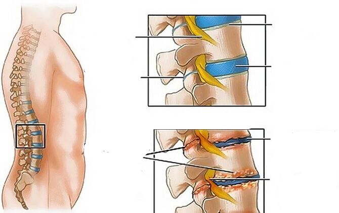 Osteochondrose der Lumbalregion