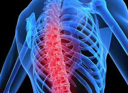 Osteochondrose der Brustwirbelsäule