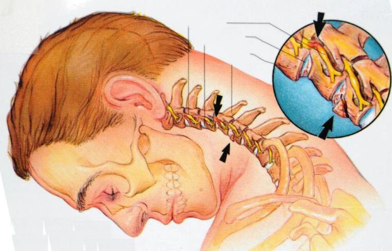 Was passiert bei zervikaler Osteochondrose