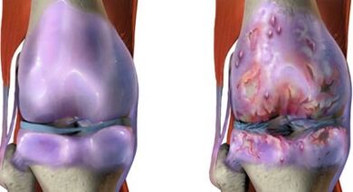 Die Hauptunterschiede bei Arthritis und Arthrose