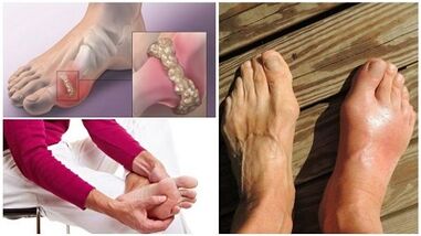 Was ist gemeinsame Arthritis